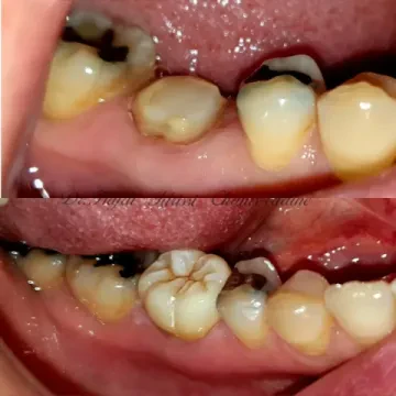 Dentaluxe - Dr Chams-Eddine Hafdi Idrissi - Chirurgie orale