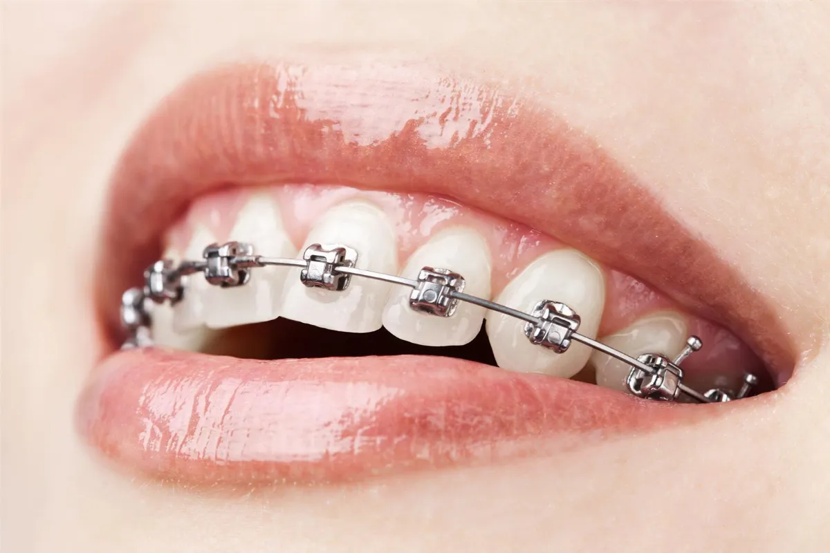 Cabinet d'Orthodontie Dr. Tber Karim - Invisalign
