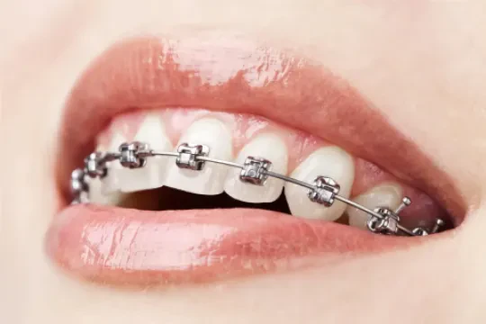 Cabinet d'Orthodontie Dr. Tber Karim - Invisalign